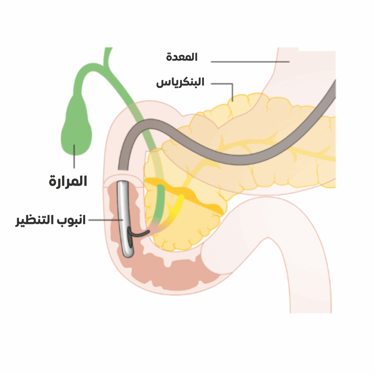 12-تصوير-القنوات-الصفراوية-والبنكرياس-بالمنظار-1200x1200.png